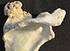 photograph of a bone with a large tumor